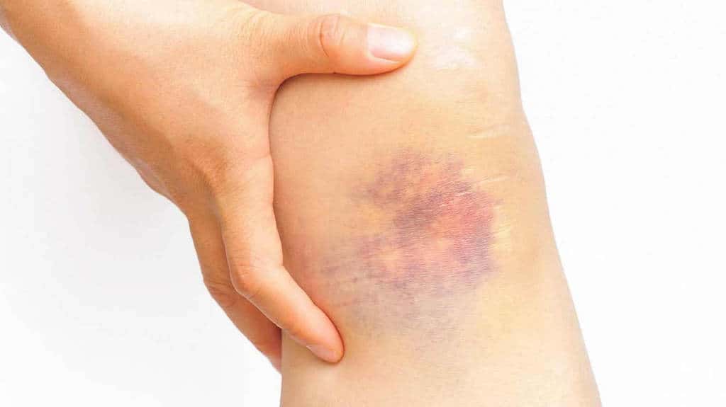 What Is A Bruise Or Contusion The Phases And How To Treatment