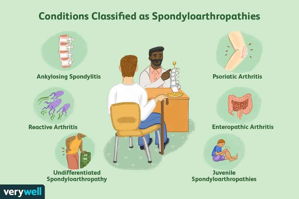 spondyloarthropathy explained  v bbdfdfaecaebfcfeb