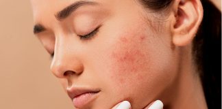 what is acne treatment reasons and solutions