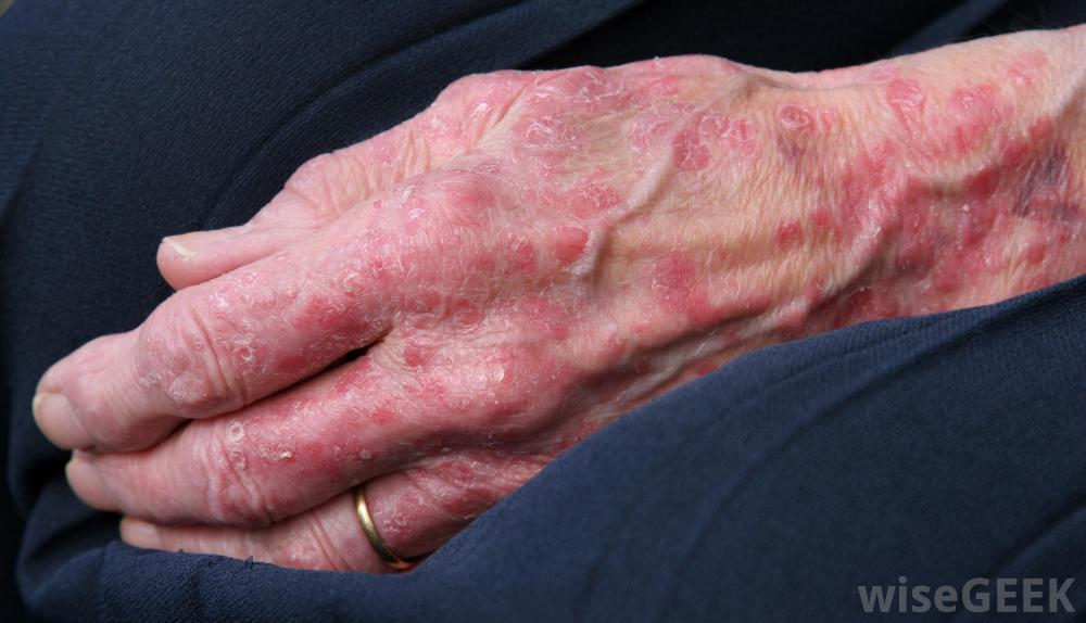 womans hand with blotchy skin rashes
