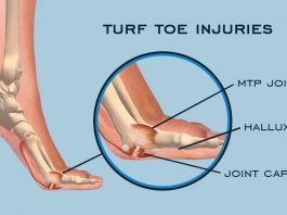 Turf Toe Injuries