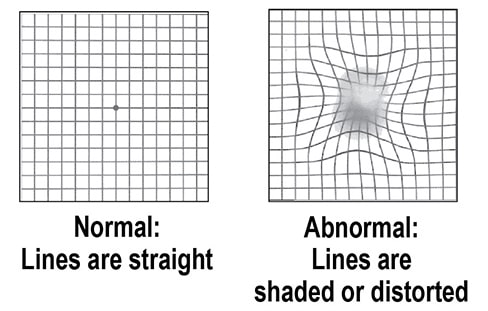 Amsler Grid side by side normal and adnormal